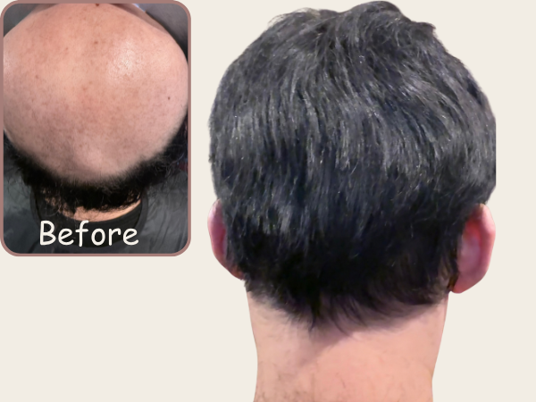 Before and after hair system result